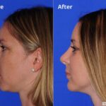 Rhinoplasty201680
