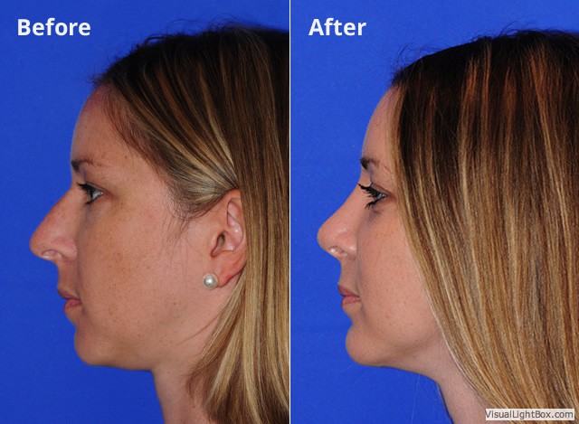 Rhinoplasty201680