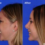 Rhinoplasty201681