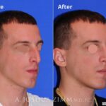 Rhinoplasty201684