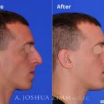 Rhinoplasty201685