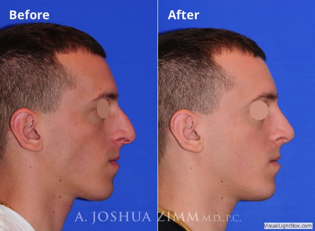 Rhinoplasty201685