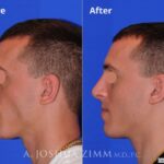 Rhinoplasty201686