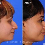Rhinoplasty201690
