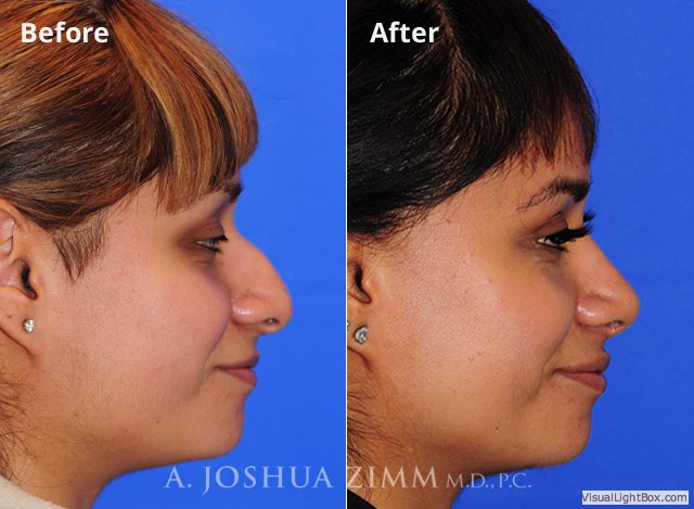 Rhinoplasty201690
