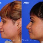 Rhinoplasty201691