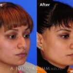 Rhinoplasty201692