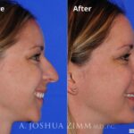 Rhinoplasty201693 1