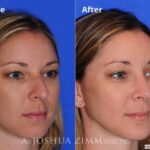 Rhinoplasty201694 1