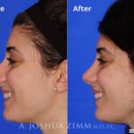 Rhinoplasty201695