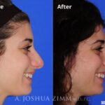 Rhinoplasty201696