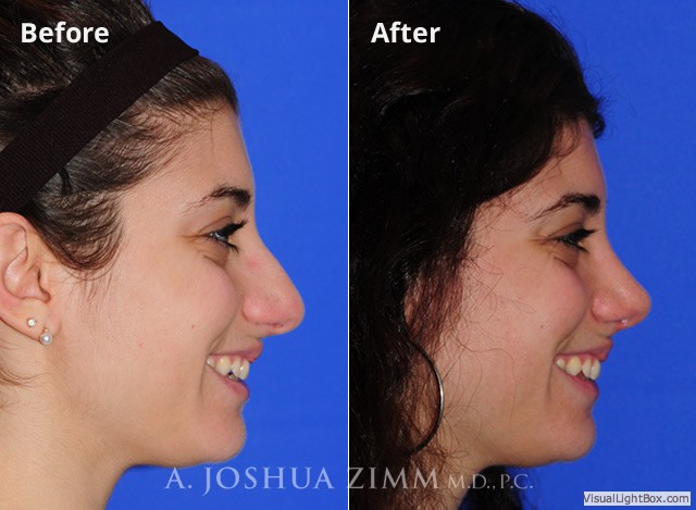 Rhinoplasty201696