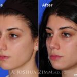 Rhinoplasty201697