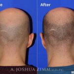 Rhinoplasty20181