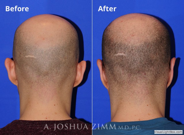 Rhinoplasty20181