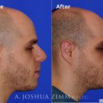 Rhinoplasty20182