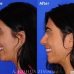 Rhinoplasty2019192leftside