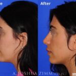 Rhinoplasty2019192leftsidenosmile