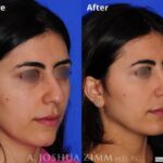 Rhinoplasty2019192obliqueleft