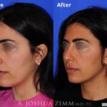 Rhinoplasty2019192oglique