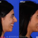 Rhinoplasty2019192rightside