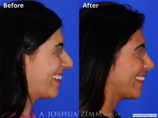 Rhinoplasty2019192rightside