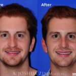 Rhinoplasty201922front