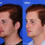 Rhinoplasty201922leftoblique