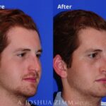 Rhinoplasty201922rightoblique