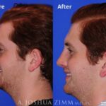 Rhinoplasty201922rightside