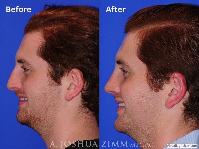 Rhinoplasty201922rightside