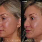 Rhinoplastychinleftobligue202162