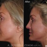 Rhinoplastychinleftside202163
