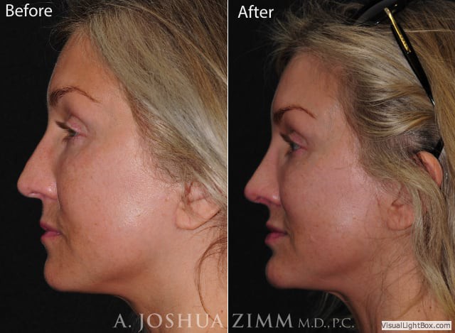 Rhinoplastychinleftside202163