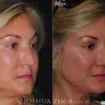 Rhinoplastychinrightobligue202164