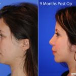 Rhinoplastycn1
