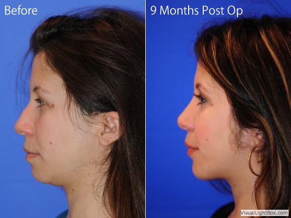 Rhinoplastycn1
