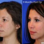Rhinoplastycn2