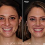 Rhinoplastyfront20201