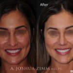 Rhinoplastyfront20212