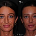 Rhinoplastyfront2021846m