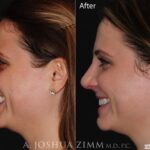 Rhinoplastyfullside20203