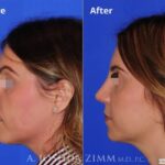 Rhinoplastyleft189