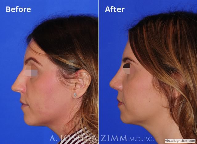 Rhinoplastyleft189