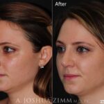 Rhinoplastyleft20202