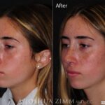 Rhinoplastyleftob2021801m