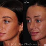Rhinoplastyleftob2021856m