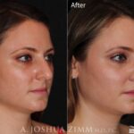Rhinoplastyleftobl20204