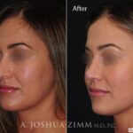 Rhinoplastyleftobl20213