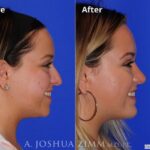 Rhinoplastyleftside190 1